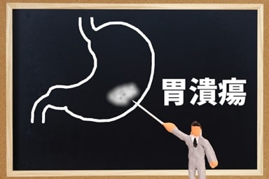 胃潰瘍・十二指腸潰瘍1