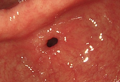 胃潰瘍・十二指腸潰瘍4